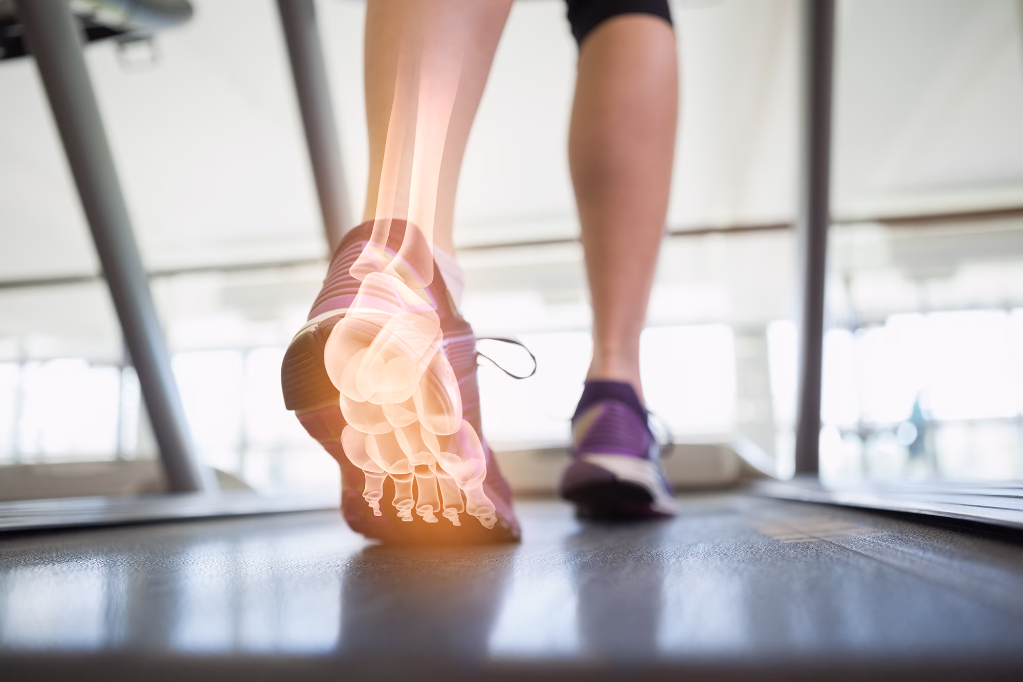 Fersensporn behandeln – Symptome, Ursachen & Therapie