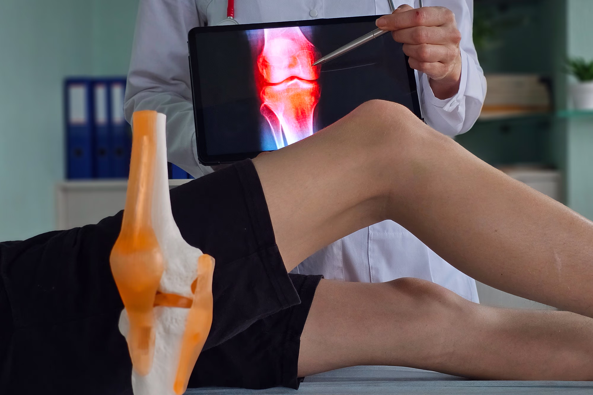 Hyaluronsäure bei Arthrose- Wirkung und Studienlage