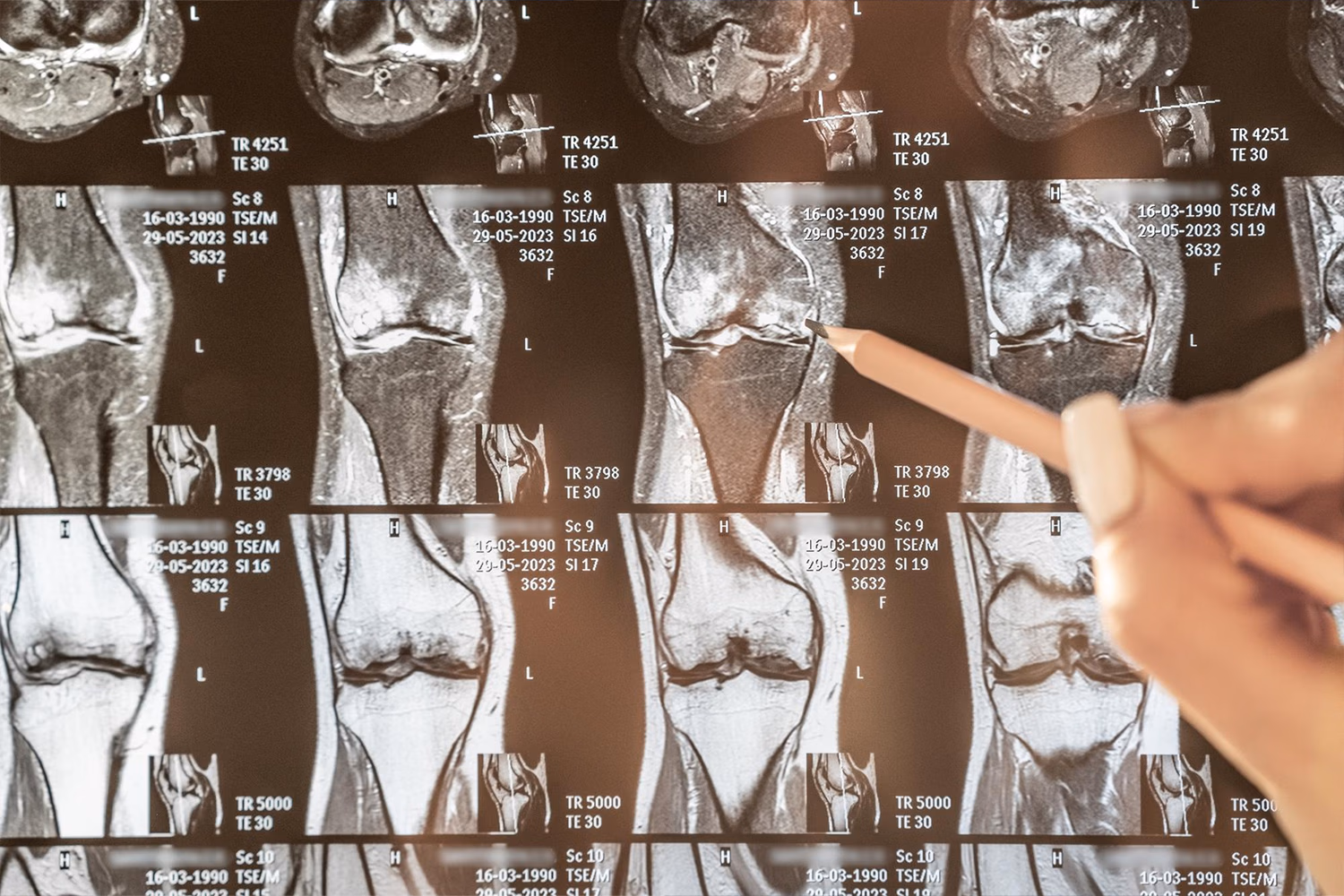 MRI Knieaufnahmen