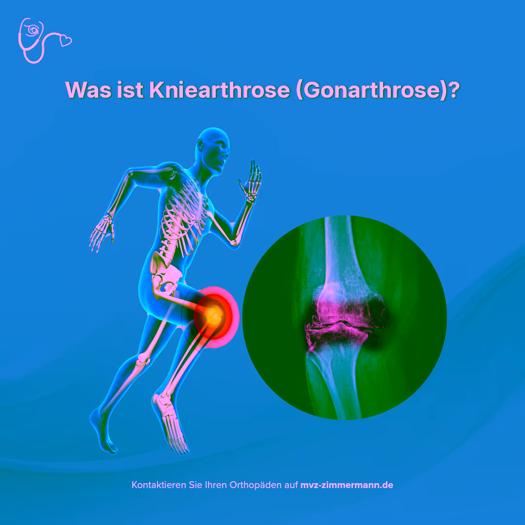 Darstellung von Kniearthrose, auch Gonarthrose genannt.