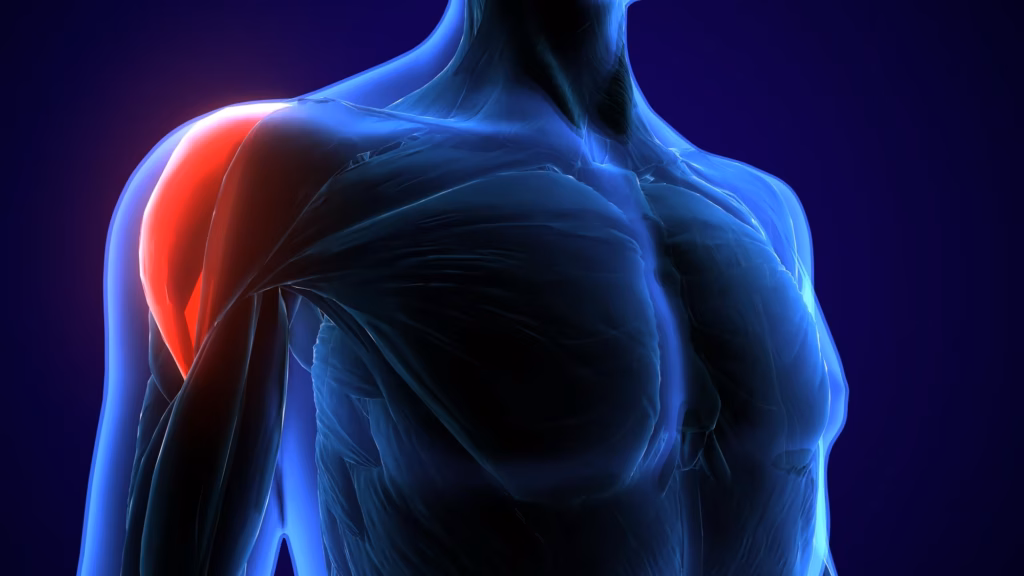 3D-visuelle Darstellung einer Kalkschulter, auch medizinisch "Tendinosis calcarea" genannt.